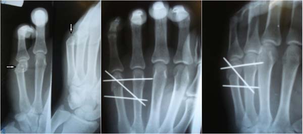 Субкапитальные переломы пястных костей