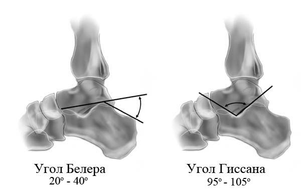 Перелом пяточной кости essex lopresti