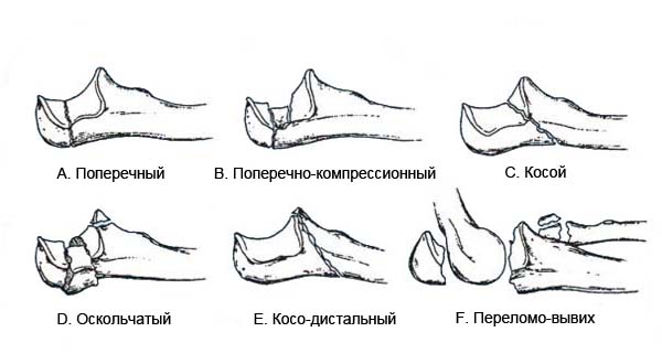 Перелом локтевого отростка классификация