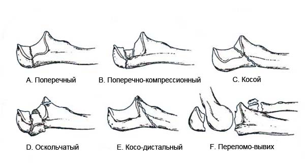 Закрытый перелом локтевого отростка история болезни