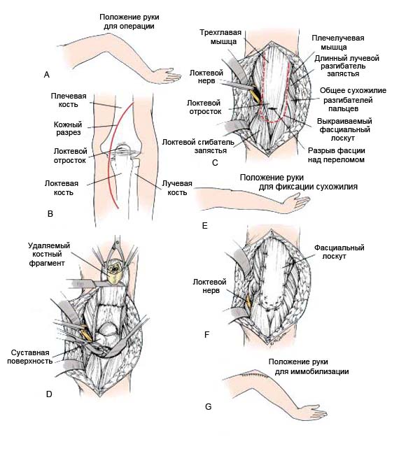 История болезни перелом локтевой кости локтевого отростка