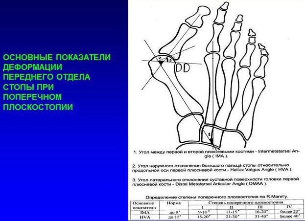 Показатели деформации переднего отдела стопы
