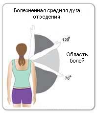 Изображение - Лфк при импиджмент синдром правого плечевого сустава boleznennaya-srednyaya-duga-otvedeniya